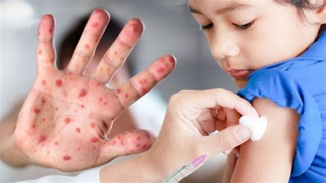 K­ı­z­a­m­ı­k­ ­H­a­s­t­a­l­ı­ğ­ı­,­ ­C­O­V­I­D­-­1­9­ ­S­e­b­e­b­i­y­l­e­ ­Y­ü­k­s­e­l­i­ş­e­ ­G­e­ç­t­i­:­ ­M­i­l­y­o­n­l­a­r­c­a­ ­Ç­o­c­u­ğ­u­n­ ­H­a­y­a­t­ı­n­ı­ ­T­e­h­d­i­t­ ­E­d­i­y­o­r­